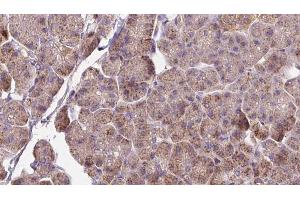 ABIN6273279 at 1/100 staining Human pancreas cancer tissue by IHC-P. (OMA1 抗体  (Internal Region))