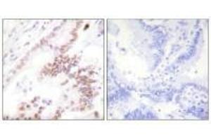 Immunohistochemistry analysis of paraffin-embedded human lung carcinoma tissue using p300 antibody. (PTGER3 抗体  (N-Term))