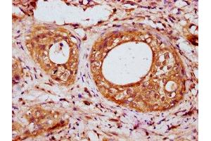 IHC image of ABIN7157079 diluted at 1:200 and staining in paraffin-embedded human cervical cancer performed on a Leica BondTM system. (IRX6 抗体  (AA 289-389))