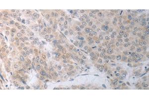 Immunohistochemistry of paraffin-embedded Human liver cancer using RBMS3 Polyclonal Antibody at dilution of 1:70