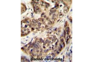 STK32A Antibody (N-term) immunohistochemistry analysis in formalin fixed and paraffin embedded human bladder carcinoma followed by peroxidase conjugation of the secondary antibody and DAB staining. (STK32A 抗体  (N-Term))