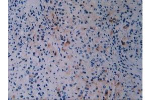 Detection of BRCA1 in Human Prostate Gland Cancer Tissue using Polyclonal Antibody to Breast Cancer Susceptibility Protein 1 (BRCA1) (BRCA1 抗体  (AA 19-83))