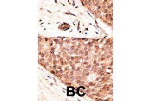 Formalin-fixed and paraffin-embedded human cancer tissue reacted with CDX2 polyclonal antibody  , which was peroxidase-conjugated to the secondary antibody, followed by AEC staining. (CDX2 抗体  (N-Term))