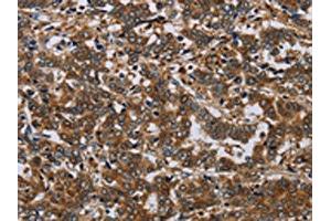 The image on the left is immunohistochemistry of paraffin-embedded Human liver cancer tissue using ABIN7191586(NCKAP1 Antibody) at dilution 1/30, on the right is treated with synthetic peptide.