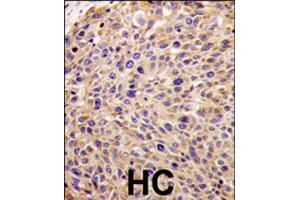 Formalin-fixed and paraffin-embedded human hepatocellular carcinoma reacted with GGPS1 polyclonal antibody  , which was peroxidase-conjugated to the secondary antibody, followed by DAB staining . (GGPS1 抗体  (N-Term))