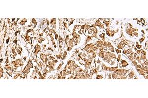 Immunohistochemistry of paraffin-embedded Human breast cancer tissue using MECR Polyclonal Antibody at dilution of 1:70(x200) (MECR 抗体)