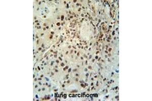 ABHEB Antibody (C-term) immunohistochemistry analysis in formalin fixed and paraffin embedded human lung carcinoma followed by peroxidase conjugation of the secondary antibody and DAB staining. (ABHD14B 抗体  (C-Term))