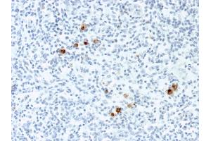 Formalin-fixed, paraffin-embedded human Hodgkin's Lymphoma stained with EBV Mouse Monoclonal Antibody (CS-4). (EBV LMP1 抗体)