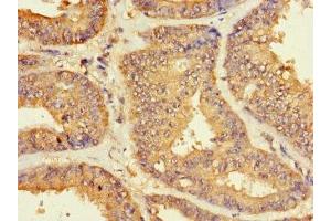 Immunohistochemistry of paraffin-embedded human endometrial cancer using ABIN7176145 at dilution of 1:100 (ZNF2 抗体  (AA 134-289))