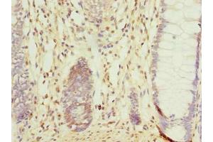Immunohistochemistry of paraffin-embedded human colon cancer using ABIN7148064 at dilution of 1:100 (CCDC16 抗体  (AA 1-280))