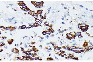 Immunohistochemistry of paraffin-embedded Human lung cancer using MMP25 Polyclonal Antibody at dilution of 1:100 (40x lens). (MMP25 抗体)
