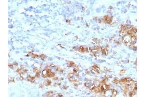 Formalin-fixed, paraffin-embedded human Gastric Carcinoma stained with CA19-9 Rabbit Recombinant Monoclonal Antibody (CA19. (CA 19-9 抗体)