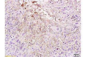 Formalin-fixed and paraffin embedded human cervical carcinoma labeled Anti-HIF-1-Alpha Polyclonal Antibody (ABIN672546), Unconjugated at 1:300, followed by conjugation to the secondary antibody and DAB staining (HIF1A 抗体  (AA 341-450))