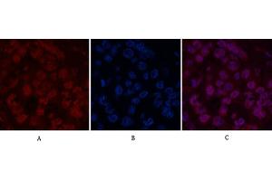 Immunofluorescence analysis of human liver cancer tissue. (Histone H2B 抗体)