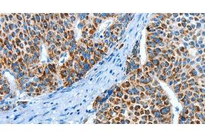 Immunohistochemistry of paraffin-embedded Human liver cancer using ALDH4A1 Polyclonal Antibody at dilution of 1:45 (ALDH4A1 抗体)