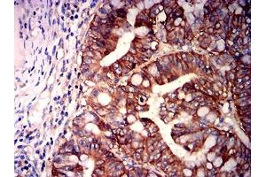 Immunohistochemical analysis of paraffin-embedded rectum cancer tissues using CD147 mouse mAb with DAB staining. (CD147 抗体  (AA 138-323))