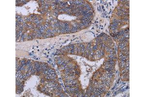 Immunohistochemistry of Human esophagus cancer using MT3 Polyclonal Antibody at dilution of 1:50 (MT3 抗体)