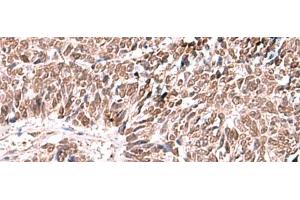 Immunohistochemistry of paraffin-embedded Human lung cancer tissue using FDPS Polyclonal Antibody at dilution of 1:60(x200) (FDPS 抗体)