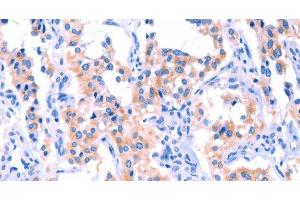 Immunohistochemistry of paraffin-embedded Human thyroid cancer tissue using ERN2 Polyclonal Antibody at dilution 1:40 (ERN2 抗体)