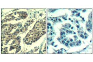 Immunohistochemical analysis of paraffin-embedded human breast carcinoma tissue using Cyclin B1(Phospho-Ser147) Antibody(left) or the same antibody preincubated with blocking peptide(right). (Cyclin B1 抗体  (pSer147))