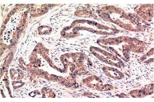 Immunohistochemistry of paraffin-embedded Human breast carcinoma tissue using Phospho-AKT1 (Ser473) Monoclonal Antibody at dilution of 1:200 (AKT1 抗体  (pSer473))
