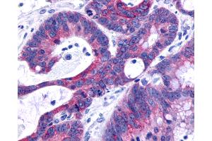 Anti-O3FAR1 / GPR120 antibody IHC of human Colon, Carcinoma. (O3FAR1 抗体  (C-Term))