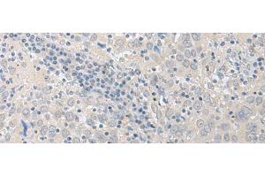 Immunohistochemistry of paraffin-embedded Human cervical cancer tissue using LYRM2 Polyclonal Antibody at dilution of 1:50(x200) (LYRM2 抗体)