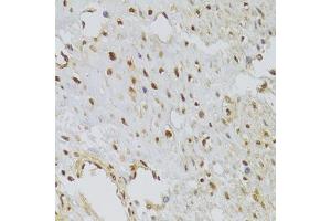 Immunohistochemistry of paraffin-embedded human leiomyoma of uterus using HNRNPA1 Antibody (ABIN5975570) at dilution of 1/100 (40x lens). (HNRNPA1 抗体)