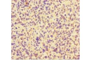 Immunohistochemistry of paraffin-embedded human glioma using ABIN7165362 at dilution of 1:100 (FAM117B 抗体  (AA 1-200))