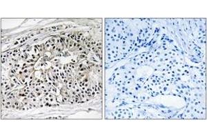 Immunohistochemistry analysis of paraffin-embedded human breast carcinoma tissue, using EHHADH Antibody. (EHHADH 抗体  (AA 476-525))