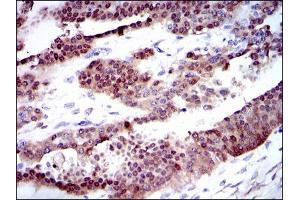 Immunohistochemical analysis of paraffin-embedded ovarian cancer tissues using CYP1A1 mouse mAb with DAB staining. (CYP1A1 抗体)