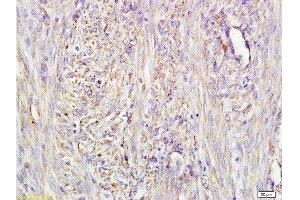 Formalin-fixed and paraffin embedded human cervical carcinoma labeled with Mouse Anti-AFP(A4) Monoclonal Antibody, Unconjugated (bsm-1622M) at 1:200 followed by conjugation to the secondary antibody and DAB staining. (alpha Fetoprotein 抗体)