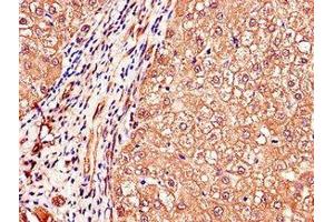 Immunohistochemistry of paraffin-embedded human liver cancer using ABIN7150398 at dilution of 1:100 (IGHMBP2 抗体  (AA 646-884))