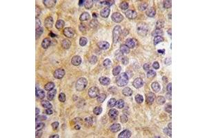 IHC analysis of FFPE human prostate carcinoma tissue stained with PRMT3 antibody (PRMT3 抗体  (AA 142-173))