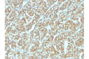 Formalin-fixed, paraffin-embedded human Thyroid Carcinoma stained with EpCAM Rabbit Recombinant Monoclonal Antibody (EGP40/1555R). (Recombinant EpCAM 抗体  (N-Term))