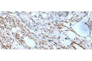 Immunohistochemistry of paraffin-embedded Human colorectal cancer tissue using GJA5 Polyclonal Antibody at dilution of 1:50(x200) (Cx40/GJA5 抗体)