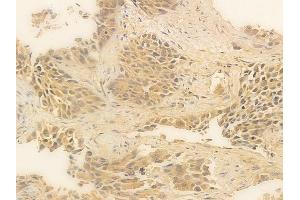 ABIN6256220 and ABIN6267281 at 1/100 staining human lung squamous cell carcinoma by IHC-P. (RAF1 抗体  (pSer259))