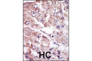 Formalin-fixed and paraffin-embedded human cancer tissue reacted with the primary antibody, which was peroxidase-conjugated to the secondary antibody, followed by AEC staining. (MARK2 抗体  (C-Term))