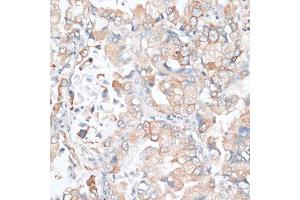 Immunohistochemistry of paraffin-embedded human lung cancer using HMGCR antibody (ABIN6293218) at dilution of 1:100 (40x lens). (HMGCR 抗体)