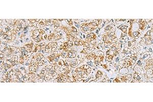 Immunohistochemistry of paraffin-embedded Human liver cancer tissue using INS(C-peptide) Polyclonal Antibody at dilution of 1:40(x200) (Insulin C-Peptide 抗体)