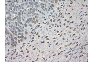 Immunohistochemical staining of paraffin-embedded Adenocarcinoma of colon tissue using anti-BUB1Bmouse monoclonal antibody. (BUB1B 抗体)