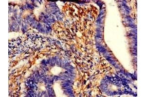 Immunohistochemistry of paraffin-embedded human colon cancer using ABIN7173558 at dilution of 1:100 (TPM3 抗体  (AA 18-224))