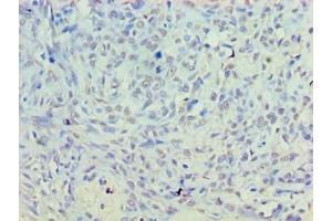 Immunohistochemistry of paraffin-embedded human breast cancer using ABIN7156167 at dilution of 1:100 (PLD5 抗体  (AA 92-536))