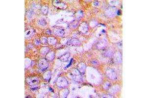 Immunohistochemical analysis of Beta-actin staining in human lung cancer formalin fixed paraffin embedded tissue section.