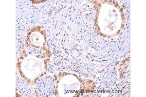 Immunohistochemistry of Human thyroid cancer using PROS1 Polyclonal Antibody at dilution of 1:60 (PROS1 抗体)