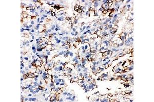 IHC-P: AQP1 antibody testing of human kidney cancer tissue (Aquaporin 1 抗体  (C-Term))