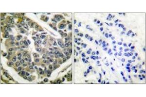Immunohistochemistry analysis of paraffin-embedded human breast carcinoma tissue, using Collagen IV Antibody. (Collagen IV 抗体  (AA 11-60))