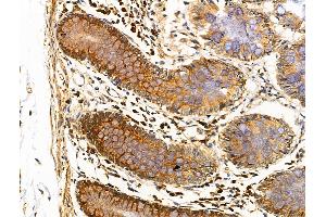 ABIN6257141 and ABIN6274489 at 1/100 staining Human colorectal cancer and adjacent normal tissues by IHC-P. (DUSP9 抗体  (Internal Region))