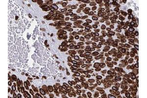 ABIN6268709 at 1/100 staining human Pancreas cancer tissues sections by IHC-P. (Lamin B 抗体)
