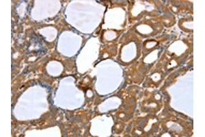 The image on the left is immunohistochemistry of paraffin-embedded Human thyroid cancer tissue using ABIN7131122(SNX11 Antibody) at dilution 1/30, on the right is treated with fusion protein. (SNX11 抗体)